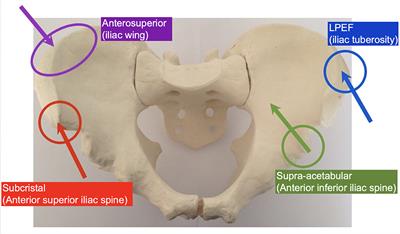 An Alternative Site for Pin Placement in External Fixation of Pelvic Fractures: Lateral Posterior Pelvic External Fixator Surgical Technique